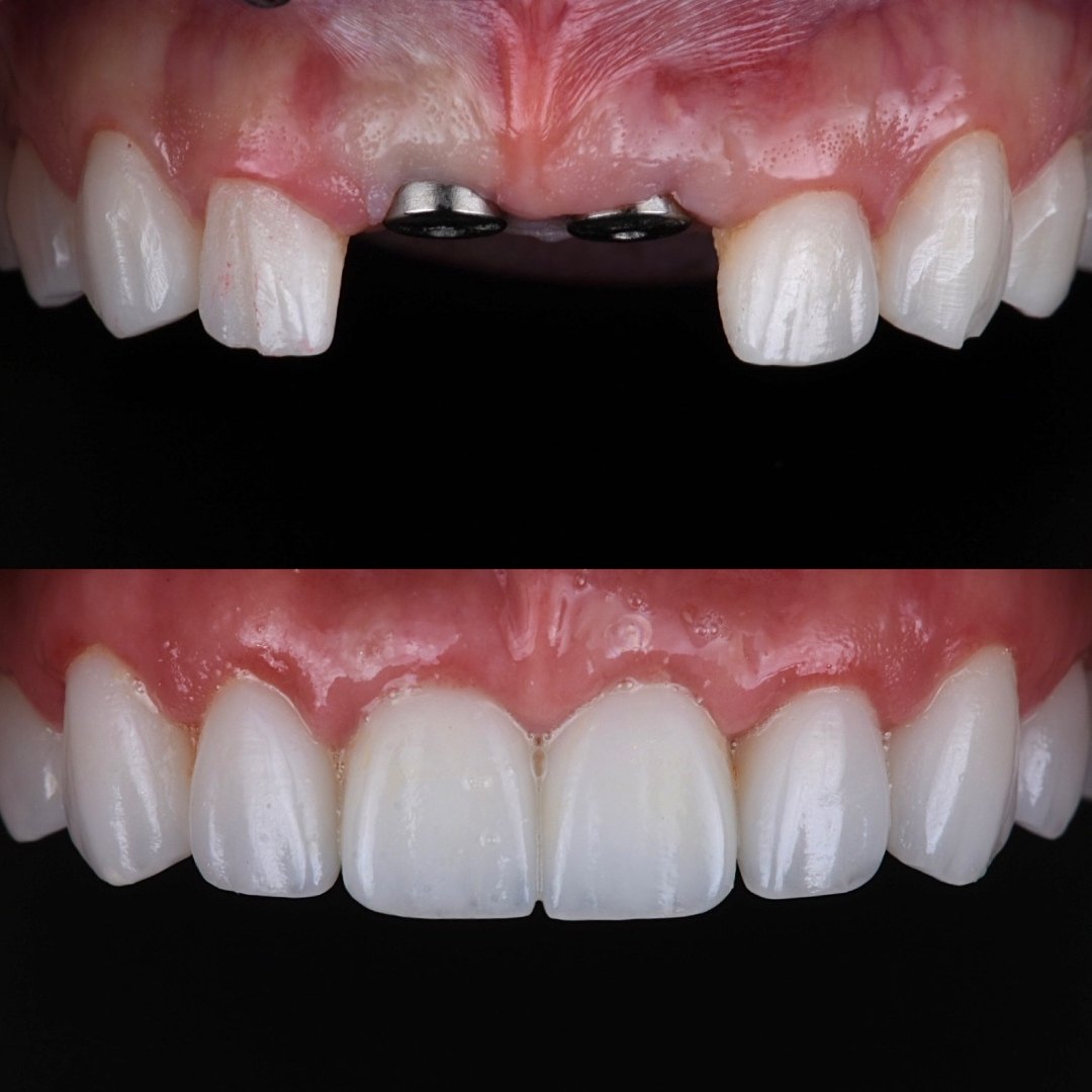 Before-and-after: two upper implants shown at placement (top) and after final porcelain crowns (bottom), treated at Modern Smiles